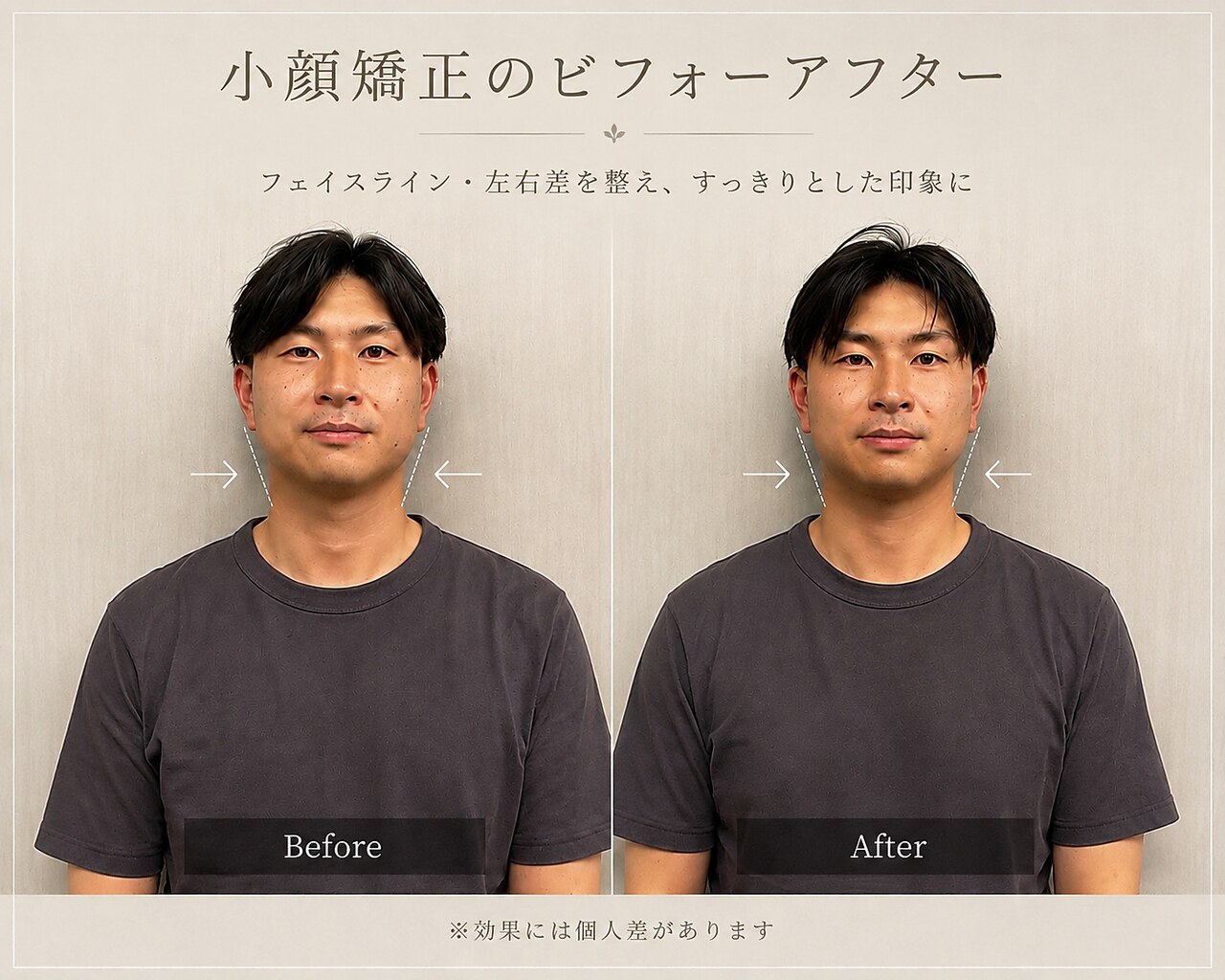 小顔矯正の施術前後の比較写真